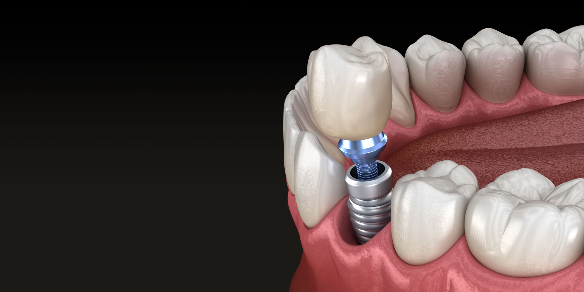 dental implants.