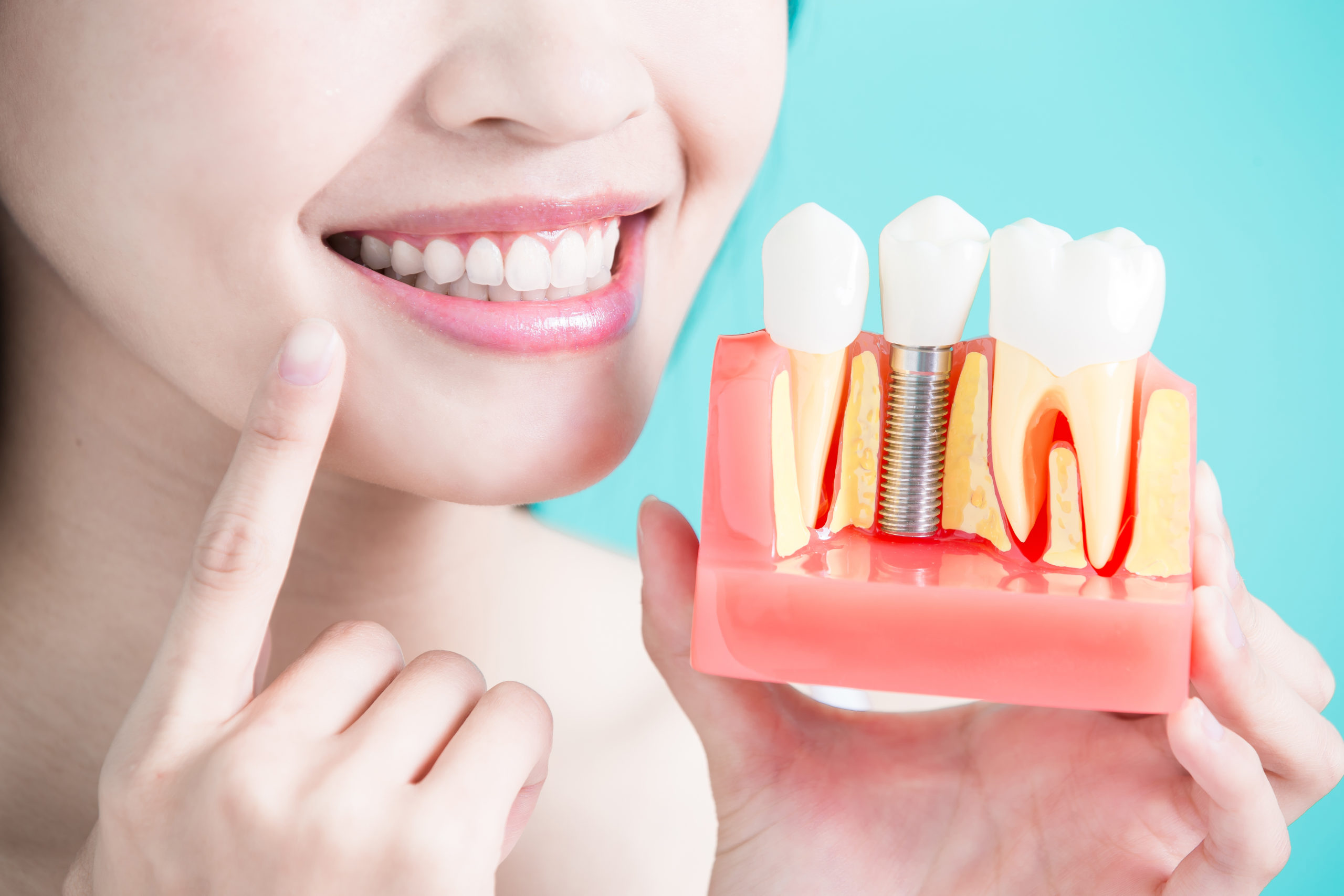 woman holding a dental implants model.