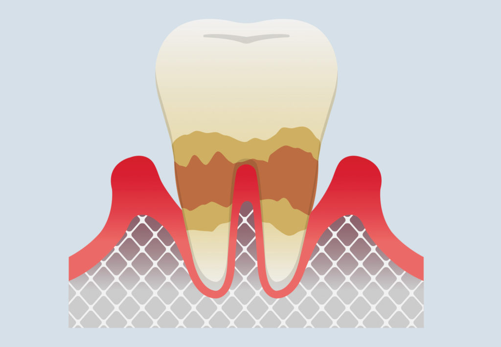 tooth with Advance Periodontitis