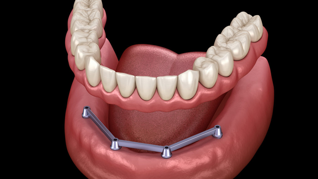 Bar implant supported dentures