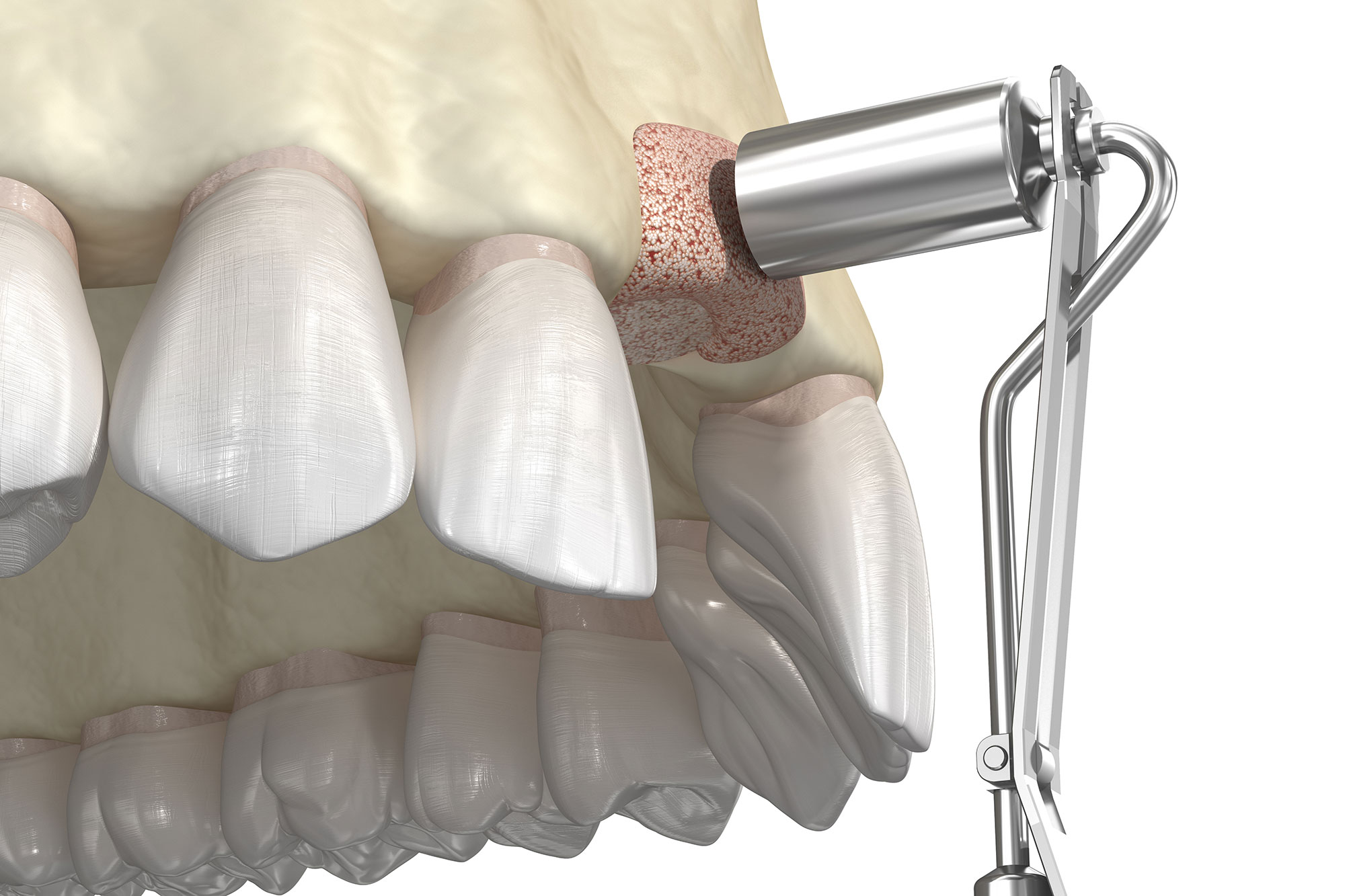 Bone Graft Withers Perio Fairfax, VA