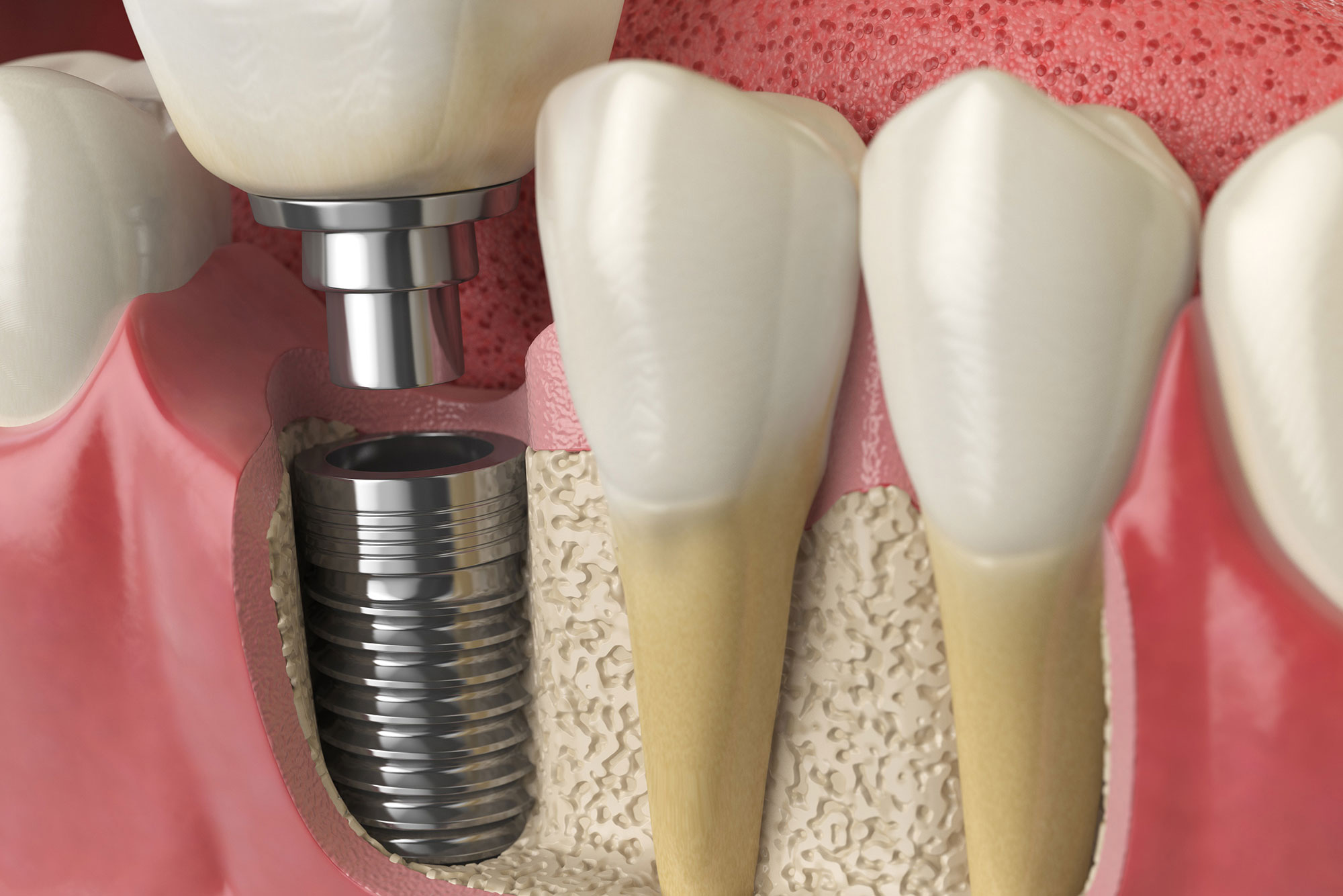 Dental implants Withers Perio Fairfax, VA