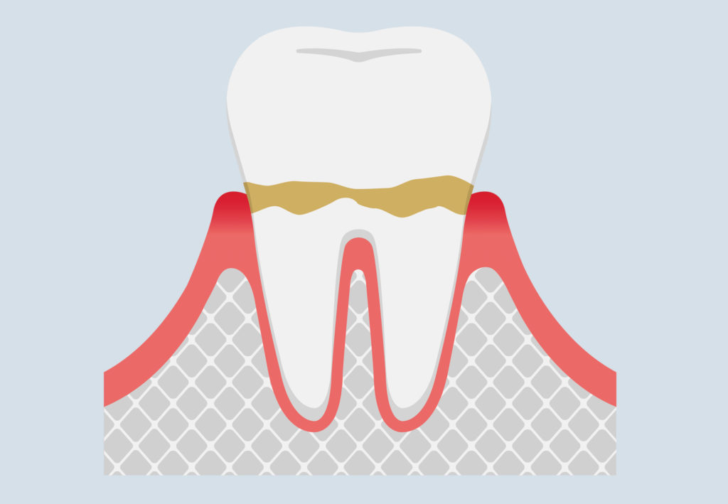 Tooth with Gingivitis