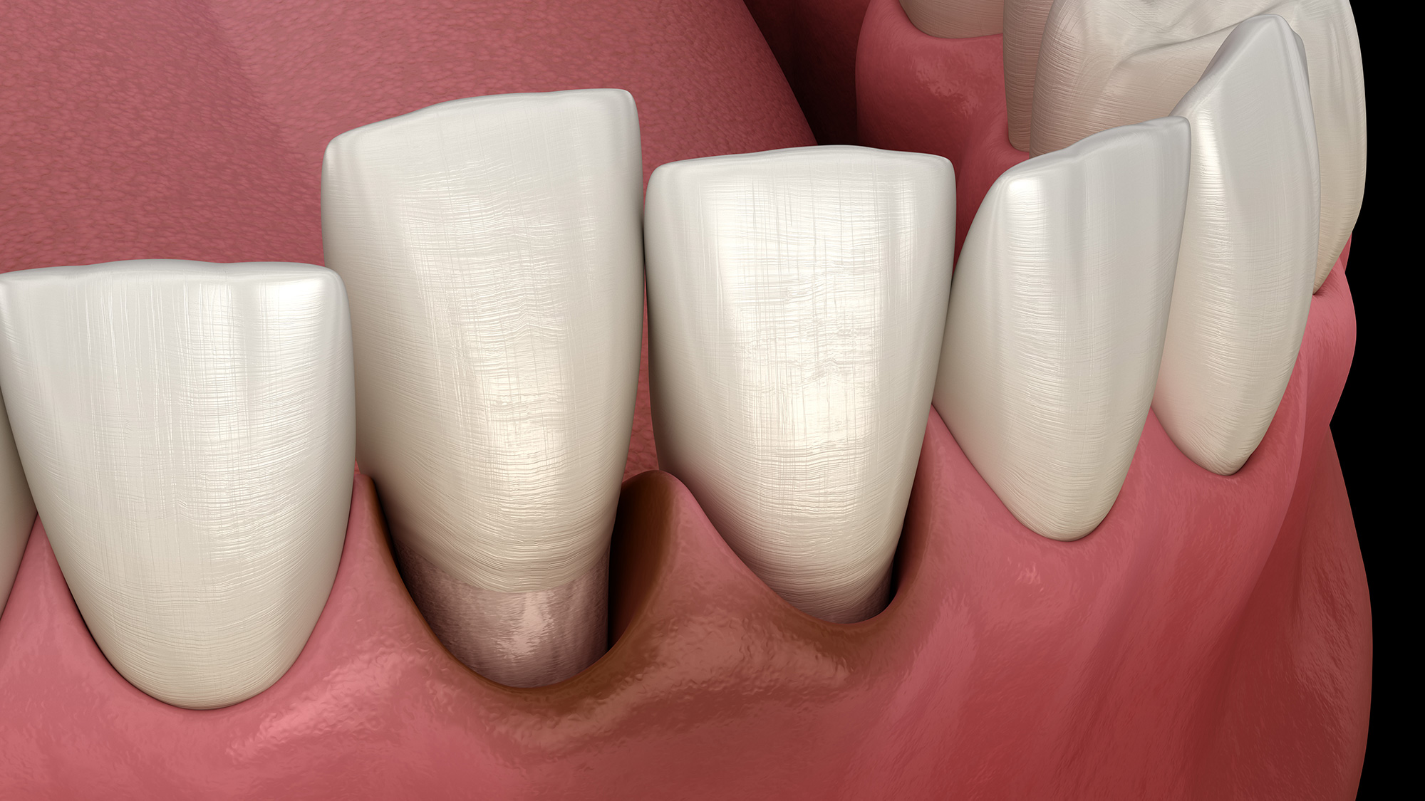Tooth and Bone Loss Withers Perio Fairfax, VA
