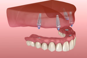 Implant Supported Dentures