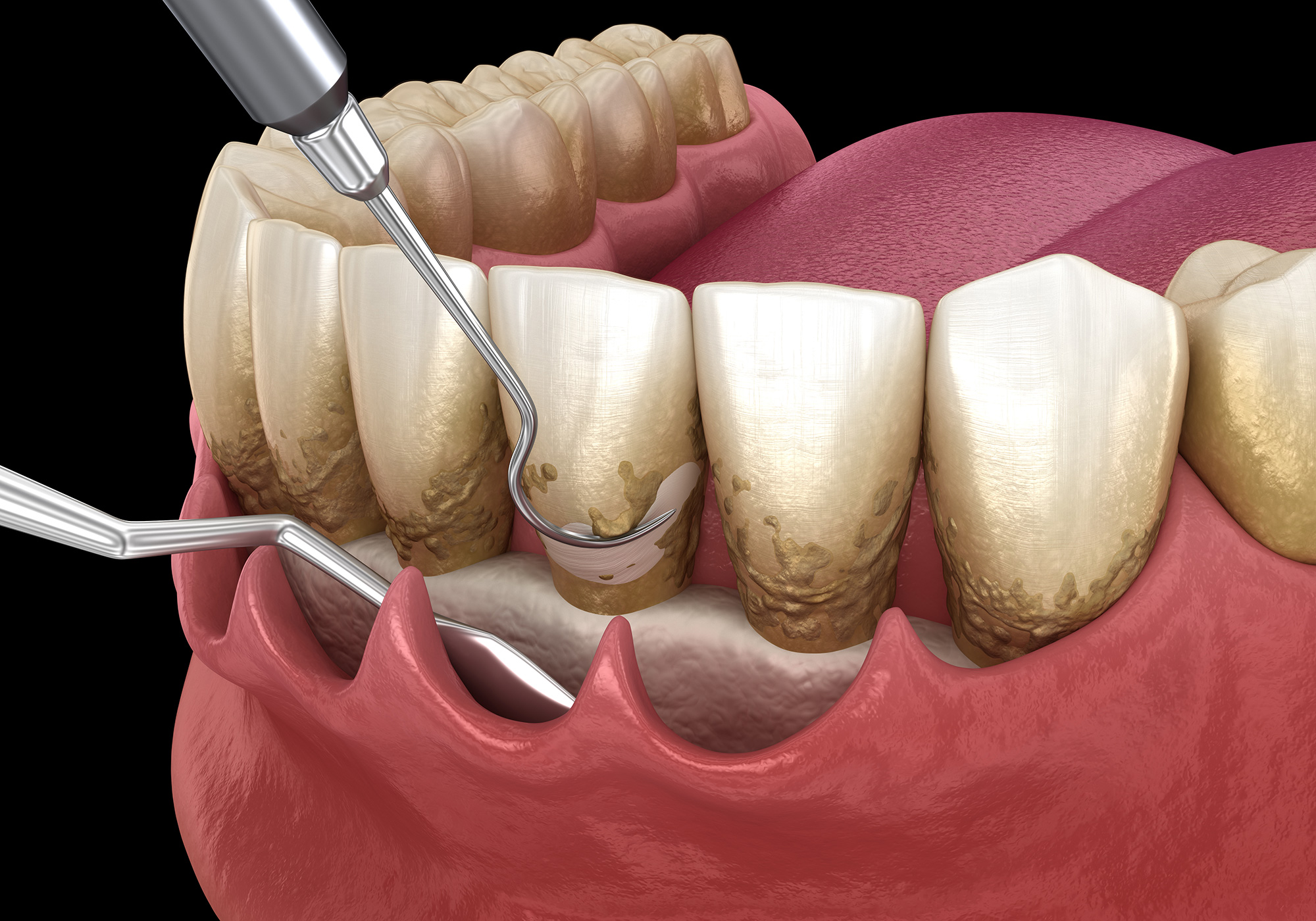 Osseous Surgery