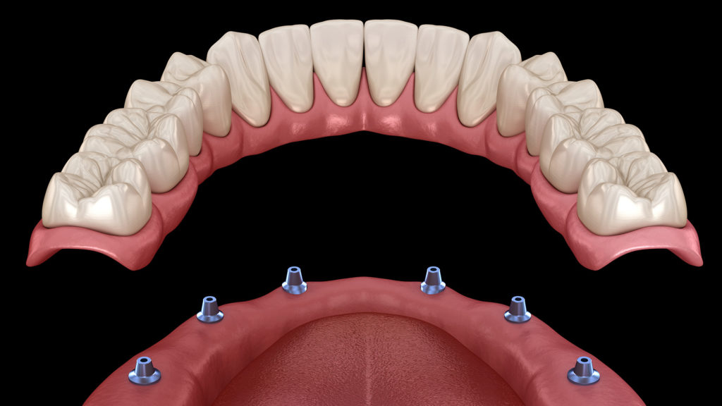 ball or stud implant supported Denture