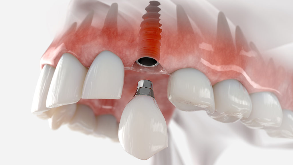 Dental implant after sinus lift