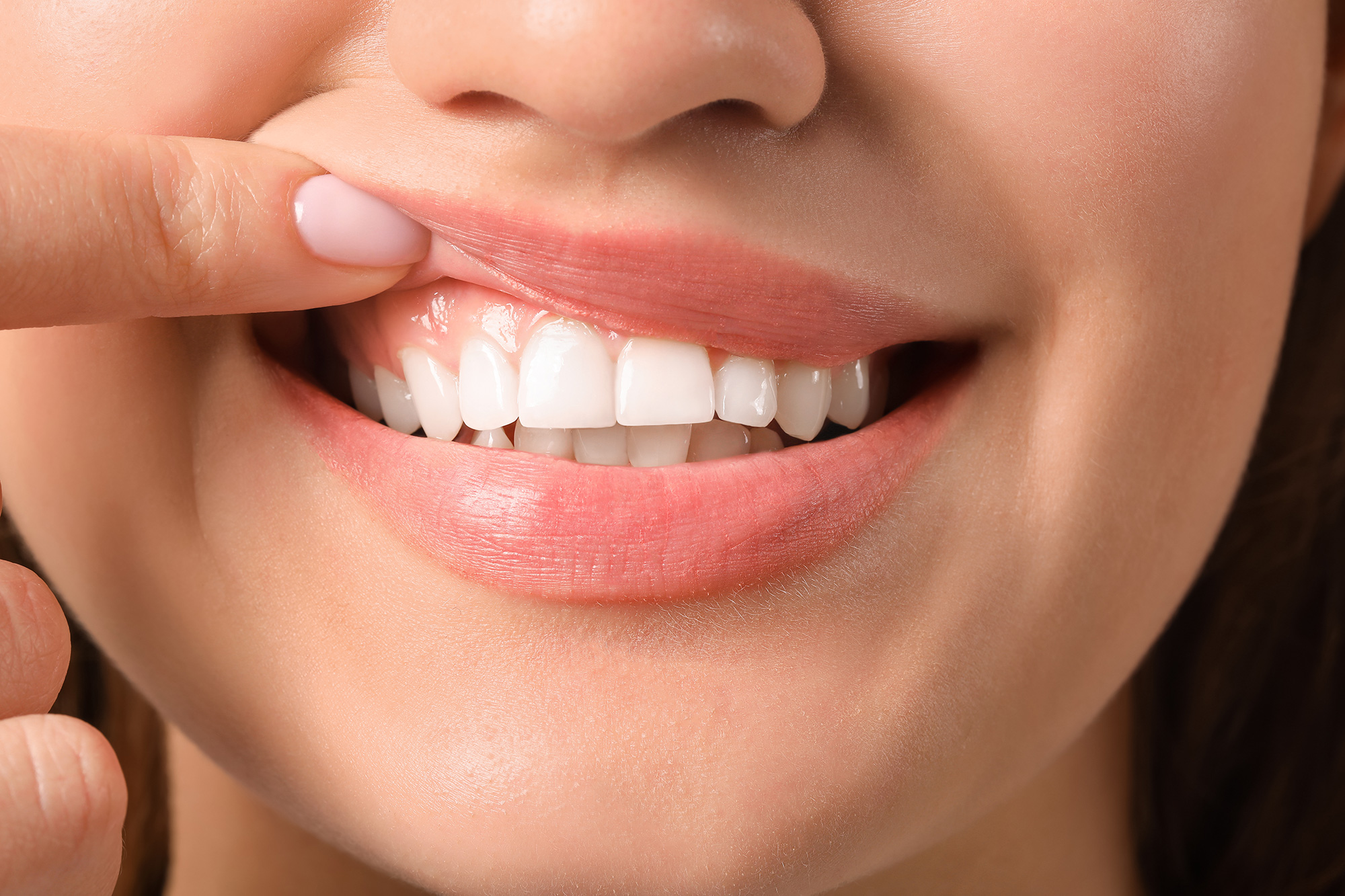 Woman with Gingivectomy