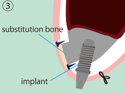 Sinus Lift process