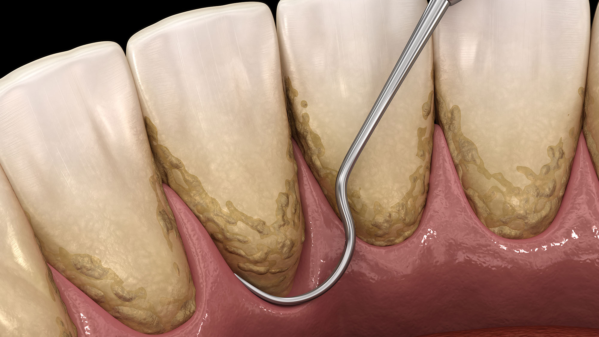 Periodontal Maintenance Withers Perio Fairfax, VA