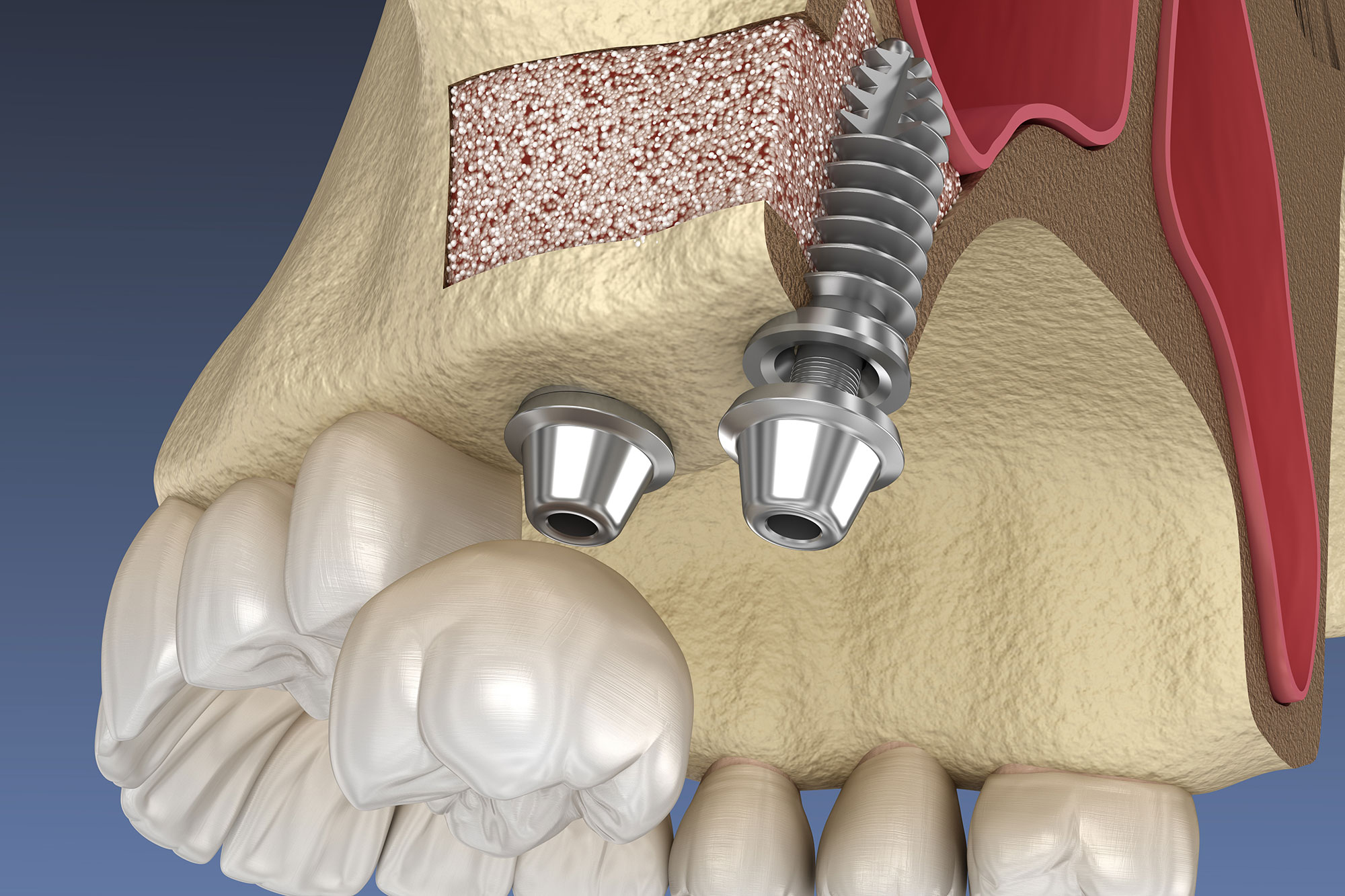 Sinus Lift