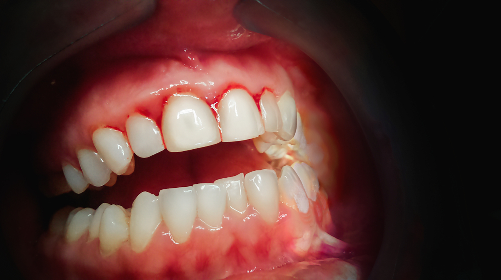 3 Easy Steps to Fighting Gum Disease