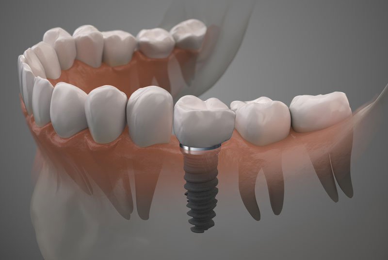Dental Implants In Mouth