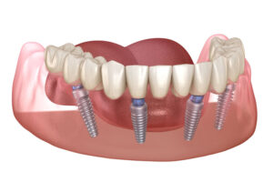 full mouth dental implants.